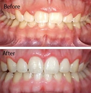 grinding of teeth during sleep treatments manjeri
